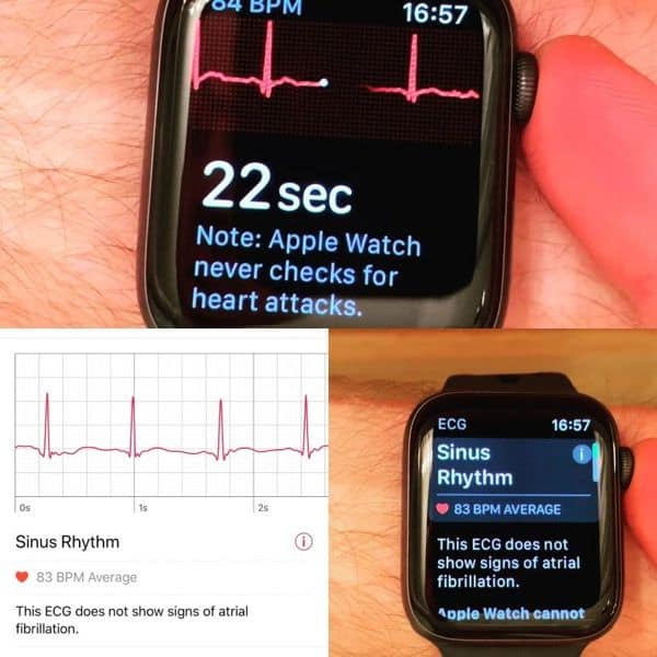 apple smartwatch ECG